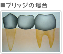 ブリッジの場合