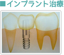 インプラント治療